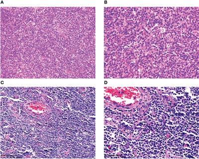 Clinicopathologic study of mantle cell lymphoma with epstein-barr virus infection: A case series and literature review